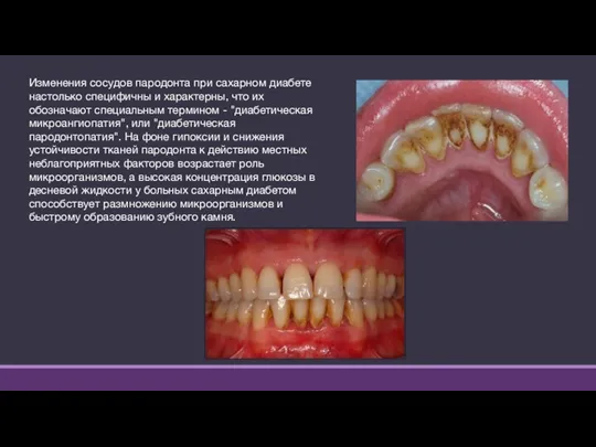 Изменения сосудов пародонта при сахарном диабете настолько специфичны и характерны,