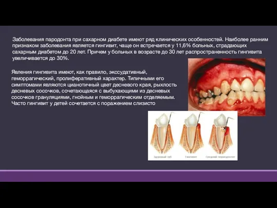 Заболевания пародонта при сахарном диабете имеют ряд клинических особенностей. Наиболее