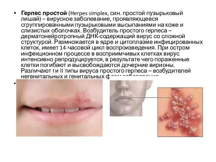 Герпес простой (Herpes simplex, син. простой пузырьковый лишай) – вирусное заболевание, проявляющееся сгруппированными