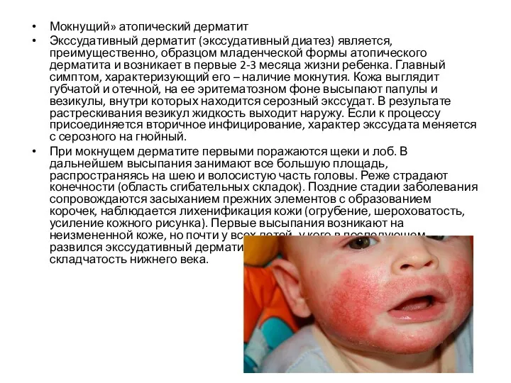 Мокнущий» атопический дерматит Экссудативный дерматит (экссудативный диатез) является, преимущественно, образцом младенческой формы атопического