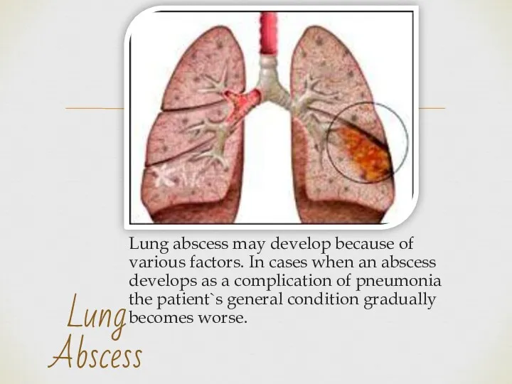 Lung abscess may develop because of various factors. In cases