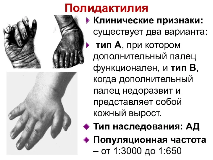Полидактилия Клинические признаки: существует два варианта: тип А, при котором дополнительный палец функционален,
