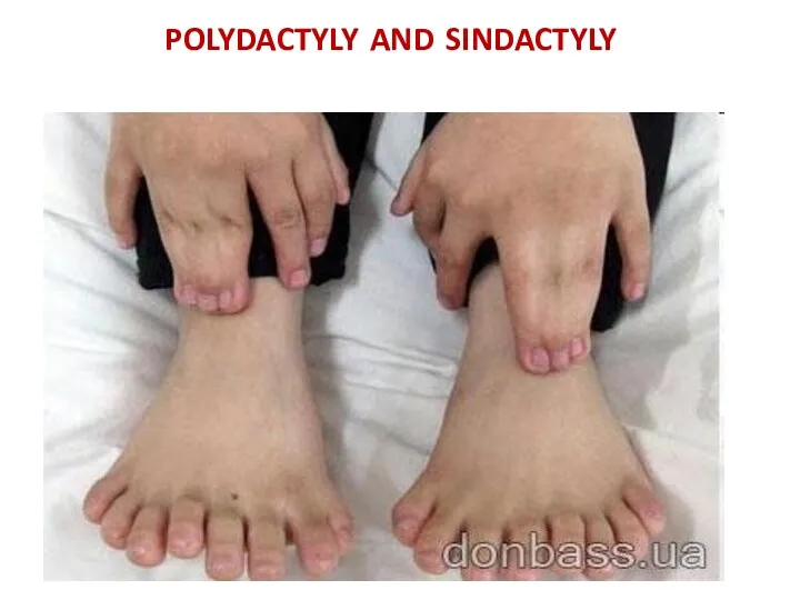 polydactyly and sindactyly