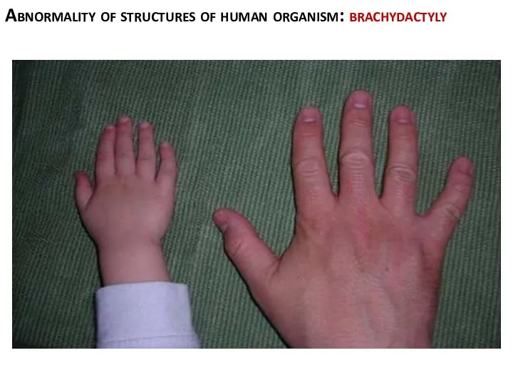 Abnormality of structures of human organism: brachydactyly