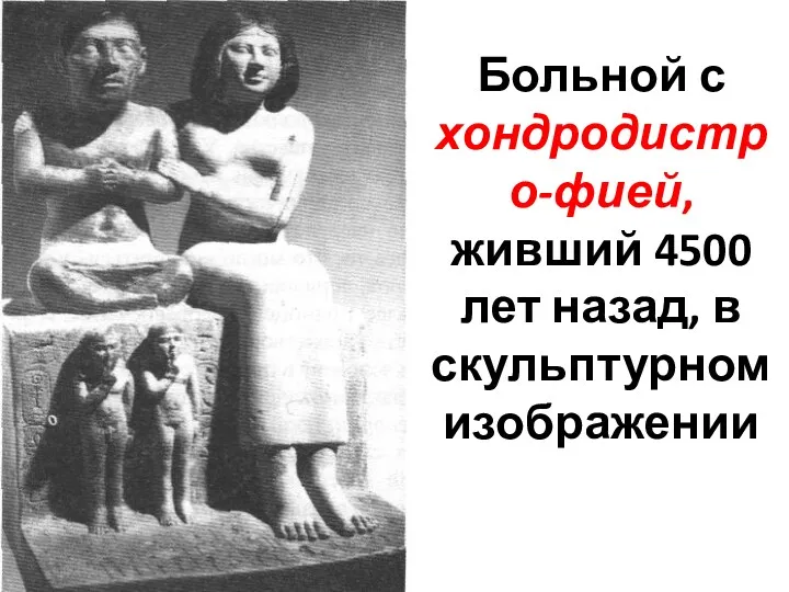 Больной с хондродистро-фией, живший 4500 лет назад, в скульптурном изображении