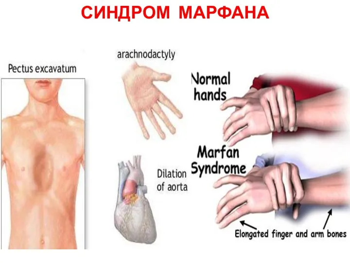 СИНДРОМ МАРФАНА