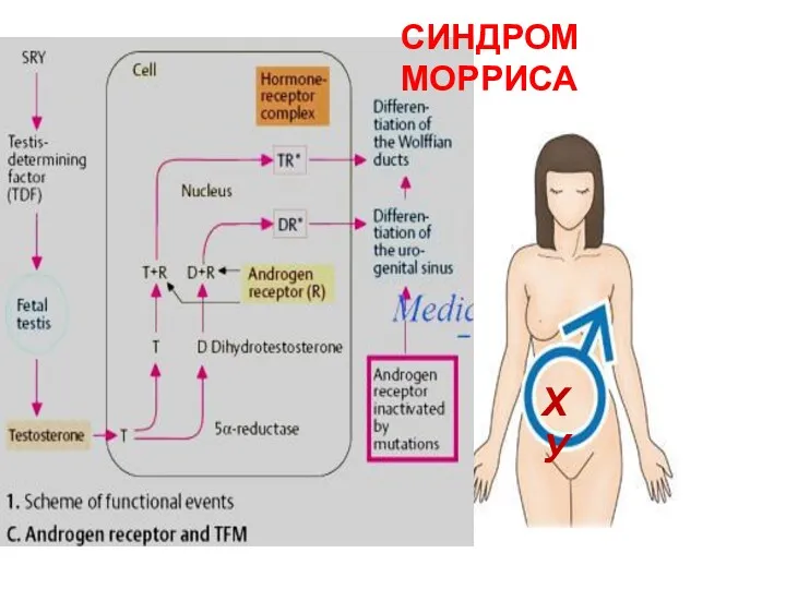 ХУ СИНДРОМ МОРРИСА