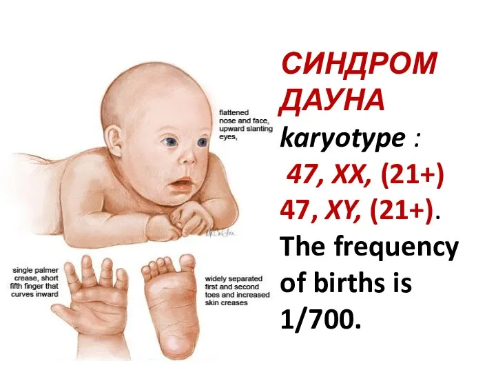 СИНДРОМ ДАУНА karyotype : 47, XX, (21+) 47, XY, (21+). The frequency of births is 1/700.