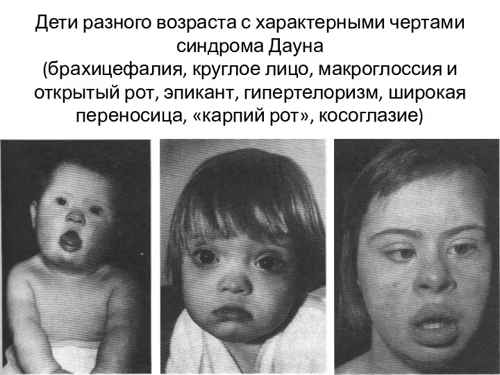 Дети разного возраста с характерными чертами синдрома Дауна (брахицефалия, круглое лицо, макроглоссия и