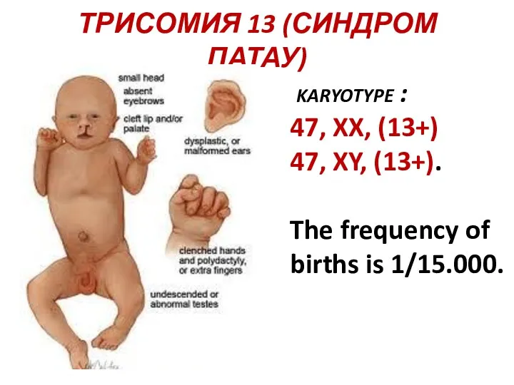 ТРИСОМИЯ 13 (СИНДРОМ ПАТАУ) karyotype : 47, XX, (13+) 47, XY, (13+). The