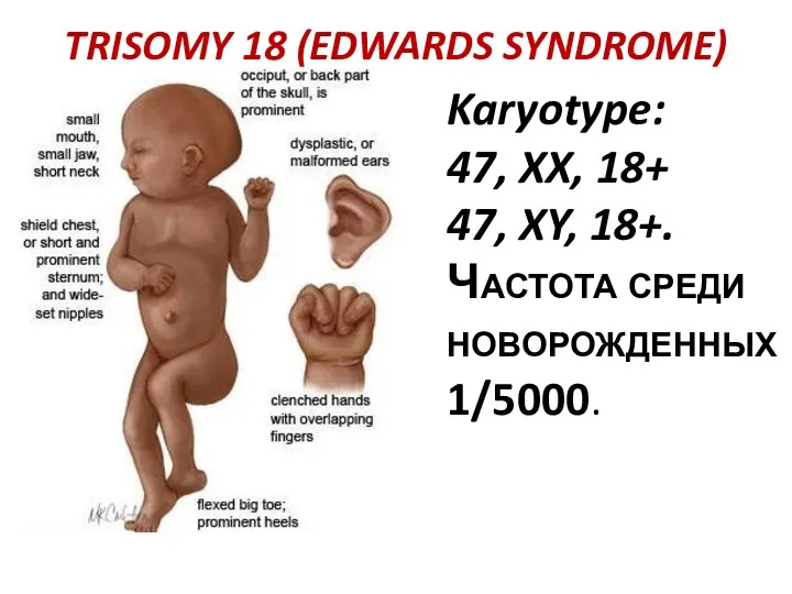 TRISOMY 18 (EDWARDS SYNDROME) Karyotype: 47, XX, 18+ 47, XY, 18+. Частота среди новорожденных 1/5000.