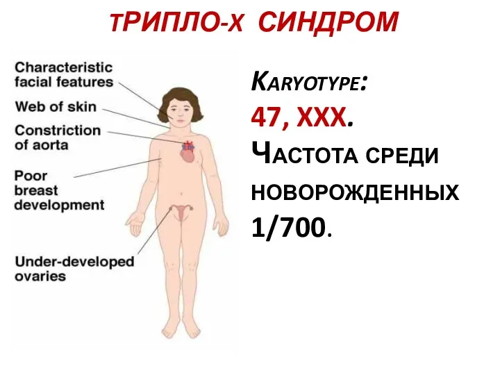 TРИПЛО-X СИНДРОМ Karyotype: 47, XXX. Частота среди новорожденных 1/700.