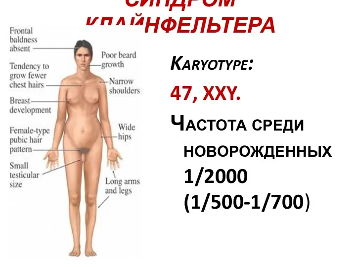 СИНДРОМ КЛАЙНФЕЛЬТЕРА Karyotype: 47, XXY. Частота среди новорожденных 1/2000 (1/500-1/700)