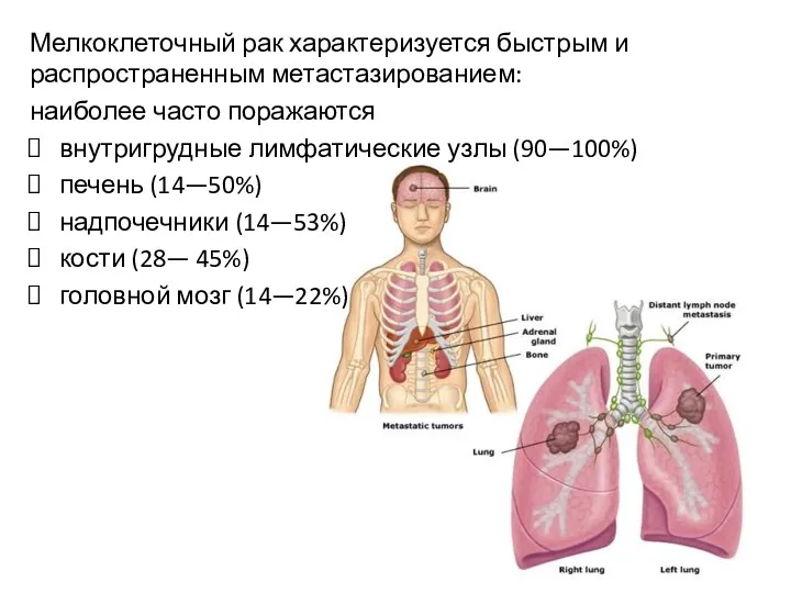 Мелкоклеточный рак характеризуется быстрым и распространенным метастазированием: наиболее часто поражаются