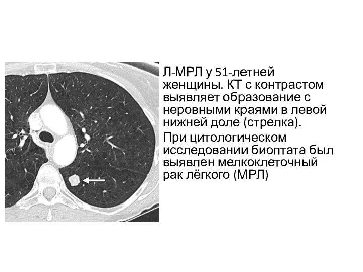 Л-МРЛ у 51-летней женщины. КТ с контрастом выявляет образование с