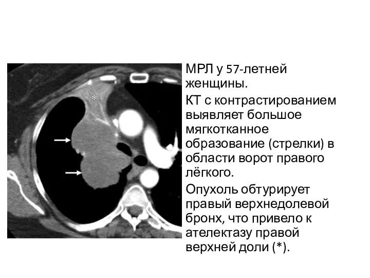 МРЛ у 57-летней женщины. КТ с контрастированием выявляет большое мягкотканное