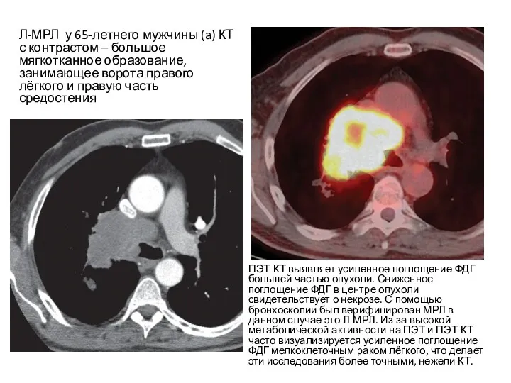 Л-МРЛ у 65-летнего мужчины (a) КТ с контрастом – большое