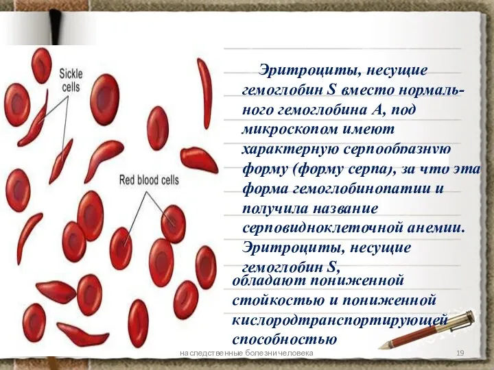 Эритроциты, несущие гемоглобин S вместо нормаль-ного гемоглобина А, под микроскопом