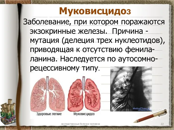 Муковисцидоз Заболевание, при котором поражаются экзокринные железы. Причина - мутация