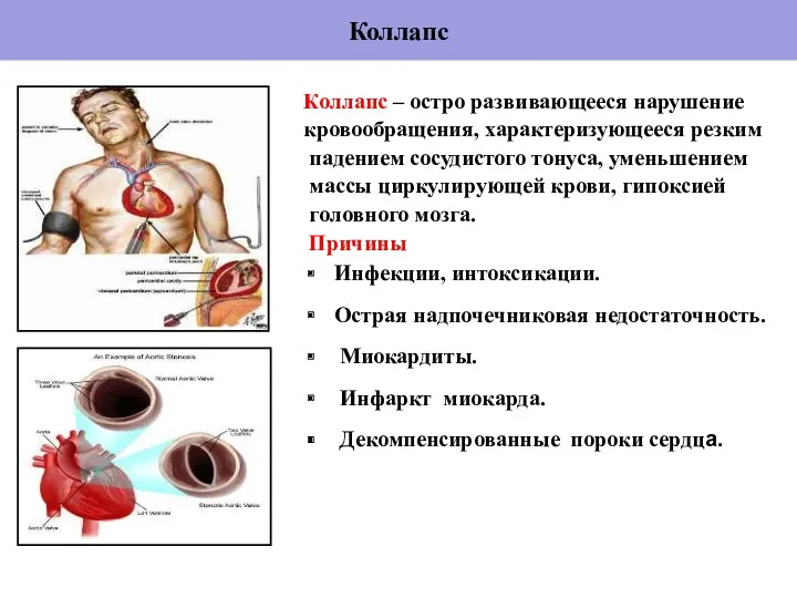 Коллапс Коллапс – остро развивающееся нарушение кровообращения, характеризующееся резким падением сосудистого тонуса, уменьшением