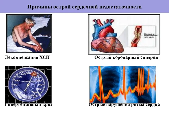 Причины острой сердечной недостаточности Декомпенсация ХСН Острый коронарный синдром Гипертензивный криз Острые нарушения ритма сердца