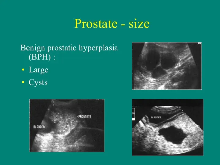 Prostate - size Benign prostatic hyperplasia (BPH) : Large Cysts