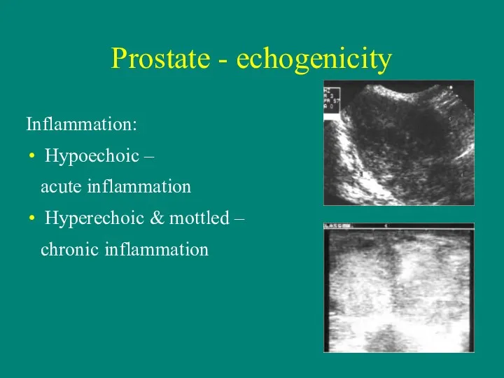 Prostate - echogenicity Inflammation: Hypoechoic – acute inflammation Hyperechoic & mottled – chronic inflammation