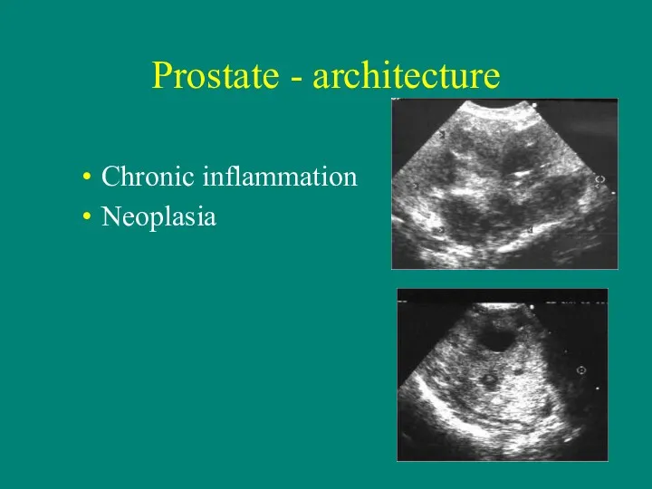 Prostate - architecture Chronic inflammation Neoplasia