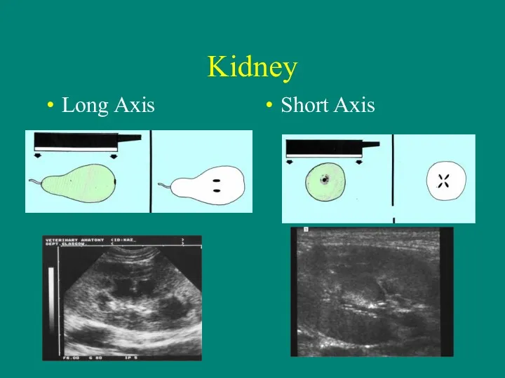Kidney Long Axis Short Axis