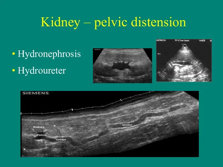 Kidney – pelvic distension Hydronephrosis Hydroureter