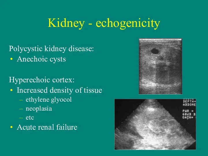 Kidney - echogenicity Polycystic kidney disease: Anechoic cysts Hyperechoic cortex: