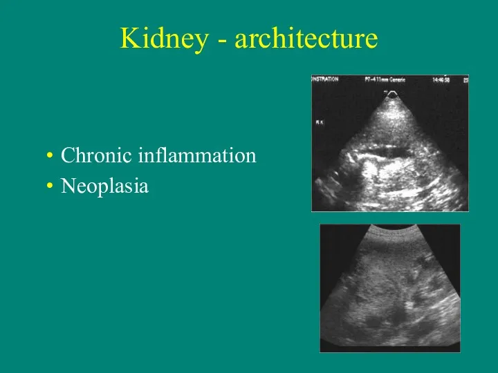 Kidney - architecture Chronic inflammation Neoplasia