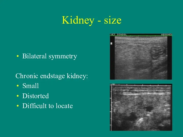Kidney - size Bilateral symmetry Chronic endstage kidney: Small Distorted Difficult to locate