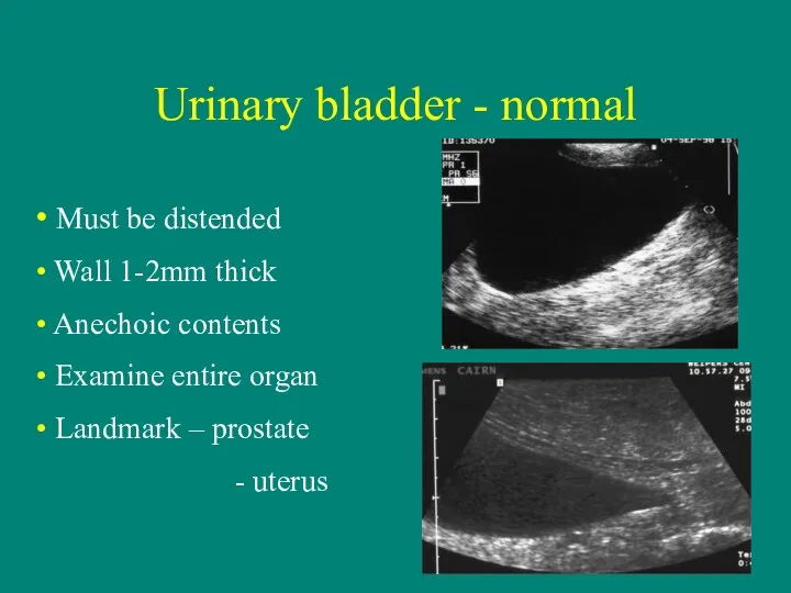 Urinary bladder - normal Must be distended Wall 1-2mm thick