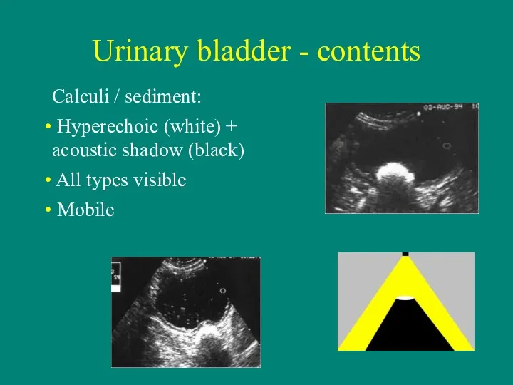 Urinary bladder - contents Calculi / sediment: Hyperechoic (white) +