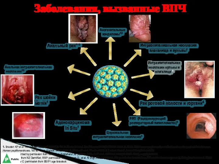 Заболевания, вызванные ВПЧ 1. Braaten KP et al. Rev Obstet Gynecol. 2008;1:2–10. 2.