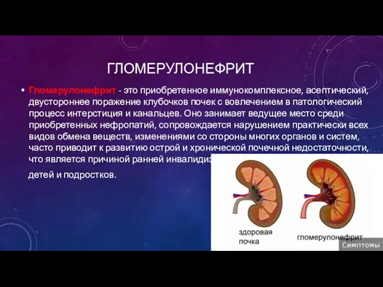 ГЛОМЕРУЛОНЕФРИТ Гломерулонефрит - это приобретенное иммунокомплексное, асептический, двустороннее поражение клубочков