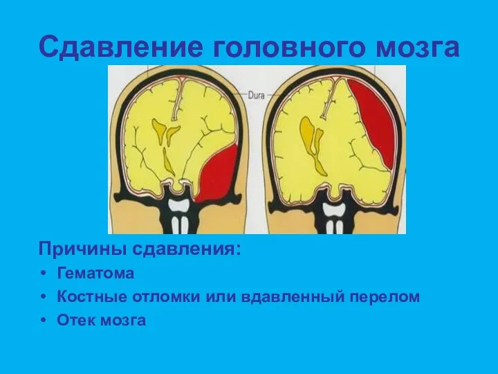 Сдавление головного мозга Причины сдавления: Гематома Костные отломки или вдавленный перелом Отек мозга