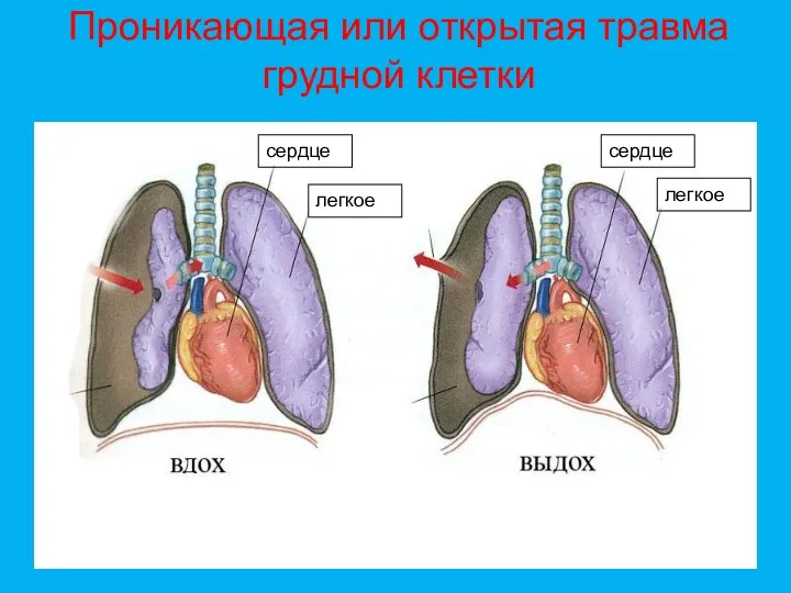 Проникающая или открытая травма грудной клетки сердце легкое легкое сердце