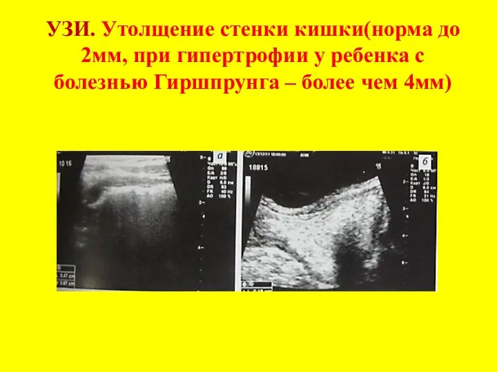 УЗИ. Утолщение стенки кишки(норма до 2мм, при гипертрофии у ребенка