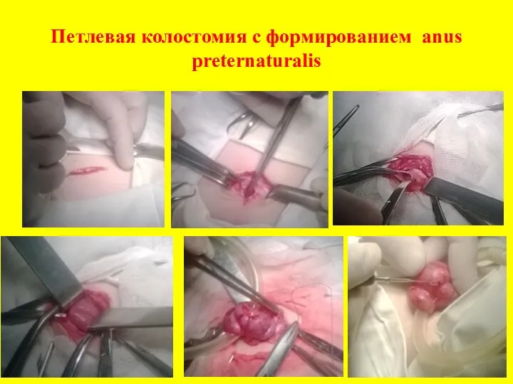 Петлевая колостомия с формированием anus preternaturalis