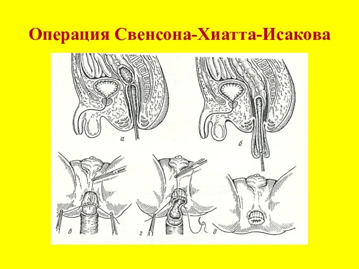 Операция Свенсона-Хиатта-Исакова