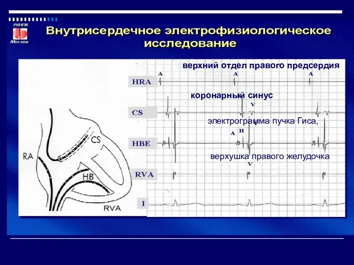 верхний отдел правого предсердия коронарный синус электрограмма пучка Гиса, верхушка правого желудочка