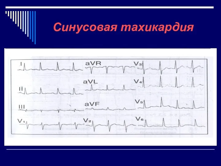 Cинусовая тахикардия