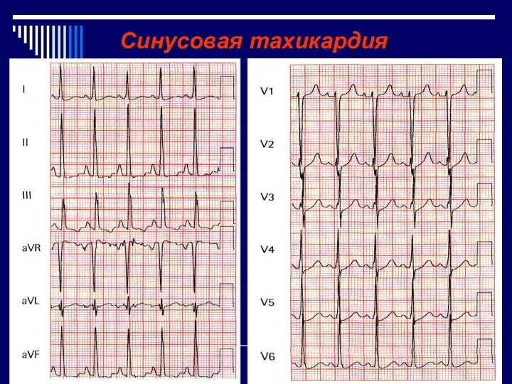 Синусовая тахикардия