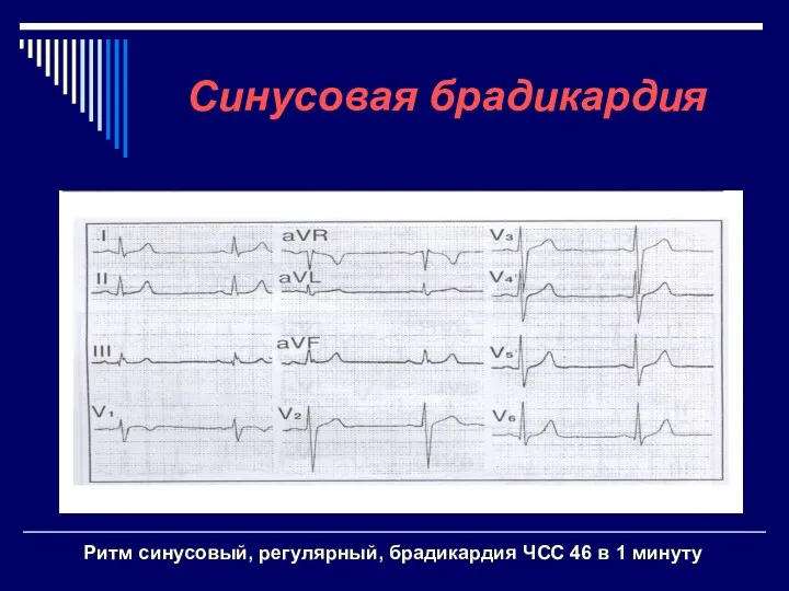 Синусовая брадикардия Ритм синусовый, регулярный, брадикардия ЧСС 46 в 1 минуту