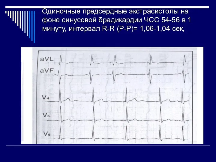 Одиночные предсердные экстрасистолы на фоне синусовой брадикардии ЧСС 54-56 в