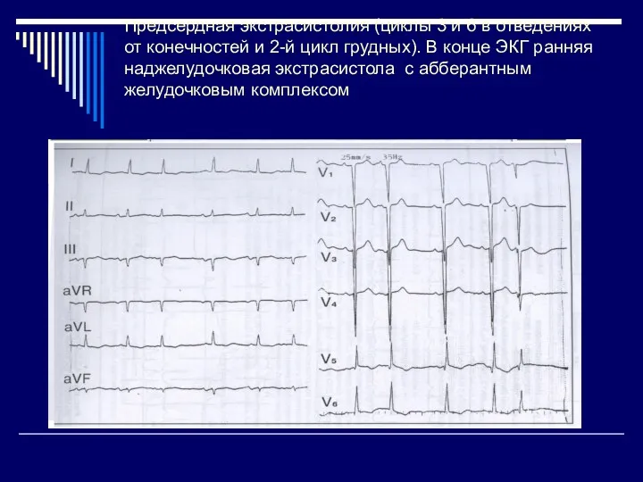 Предсердная экстрасистолия (циклы 3 и 6 в отведениях от конечностей
