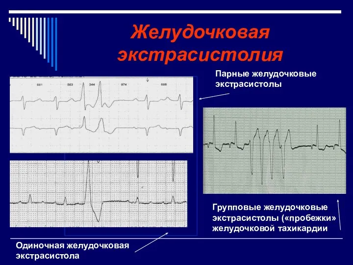 Желудочковая экстрасистолия Групповые желудочковые экстрасистолы («пробежки» желудочковой тахикардии Парные желудочковые экстрасистолы Одиночная желудочковая экстрасистола