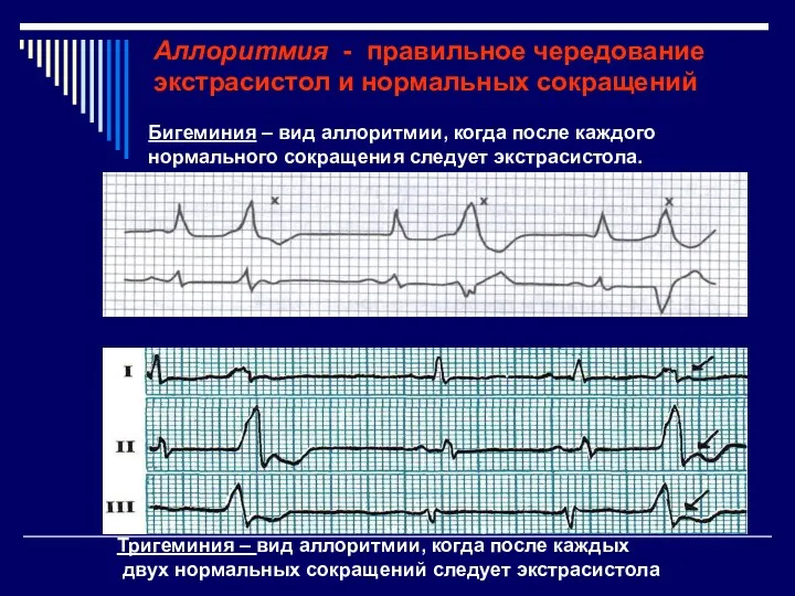 Аллоритмия - правильное чередование экстрасистол и нормальных сокращений Бигеминия –